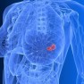 Wzrasta zachorowalność na raka piersi